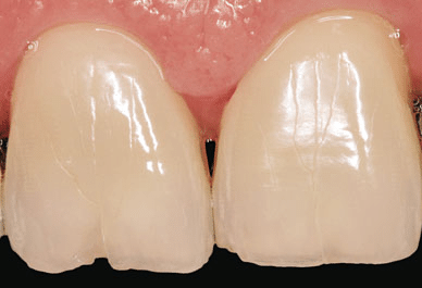 Incisor Incisal Filling