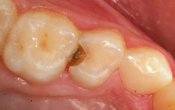 Two Surface Cavity