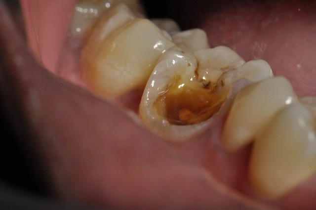 3 Surface Cavity