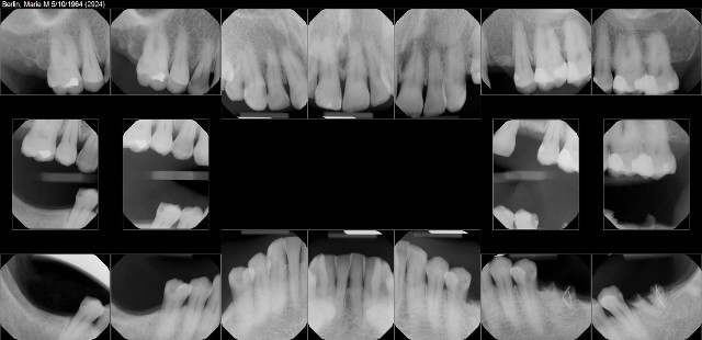 digital x-rays 