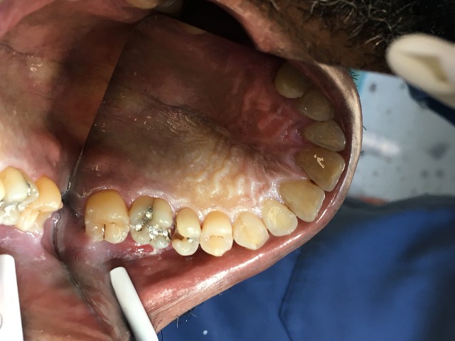 cavity