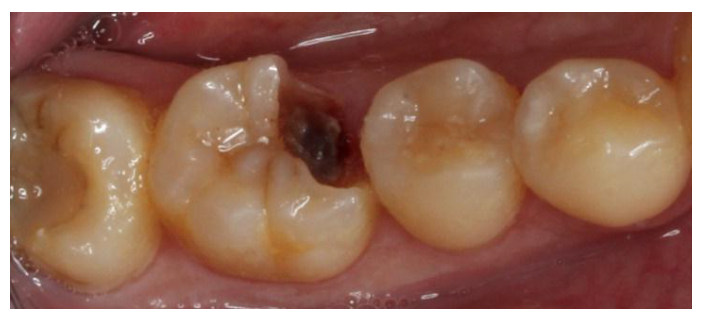 tooth#30