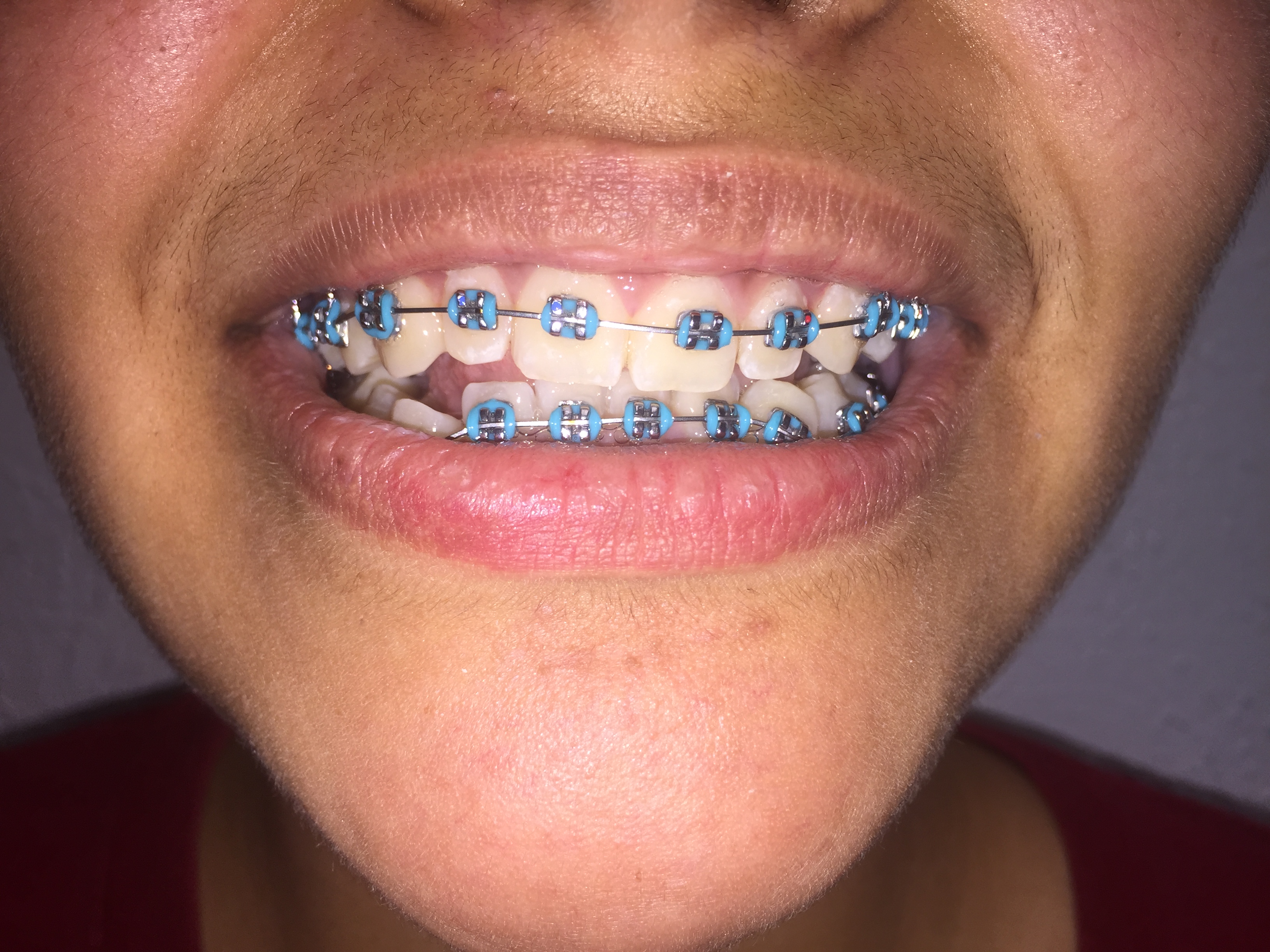Braces