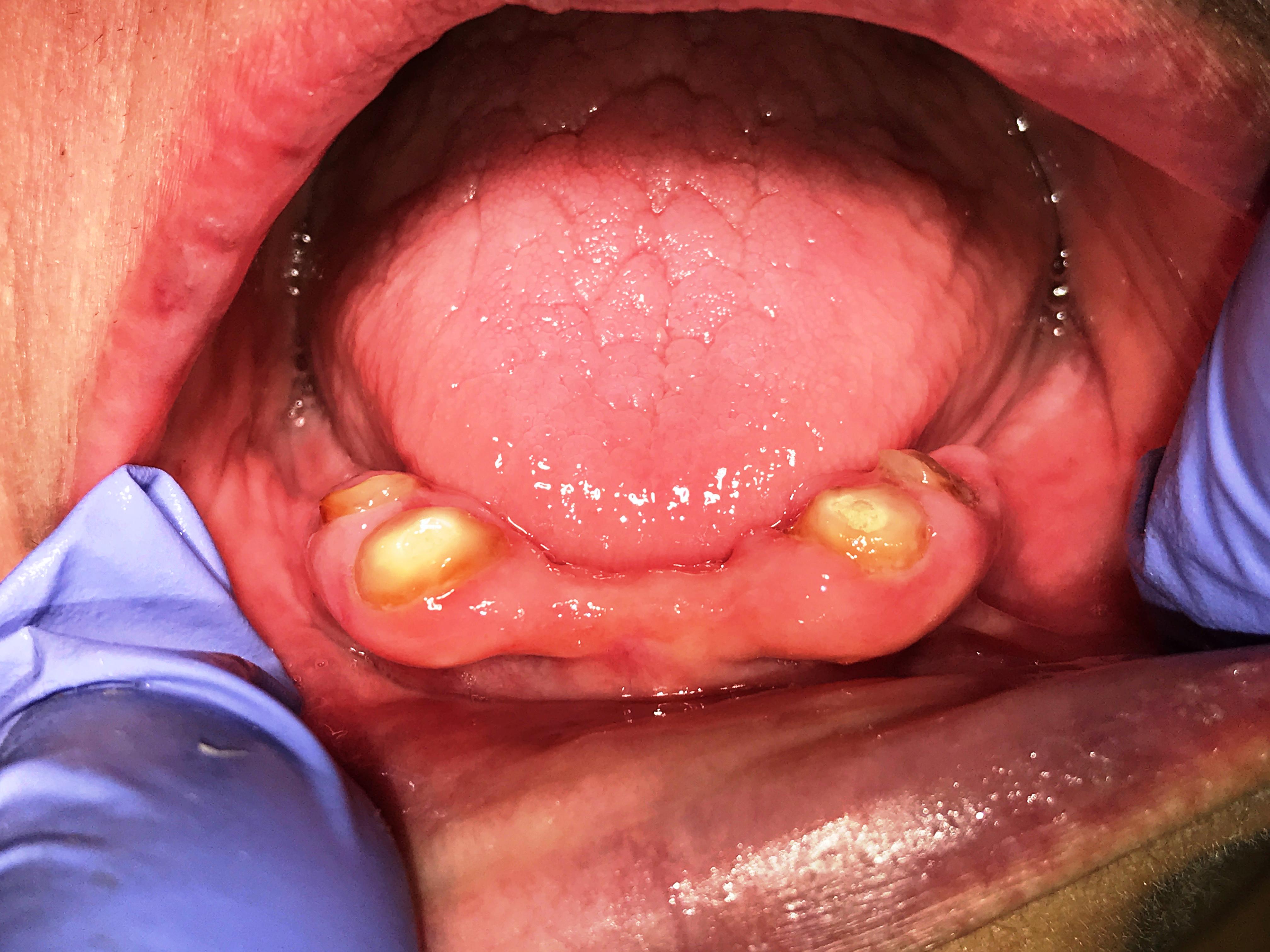 root retained denture 