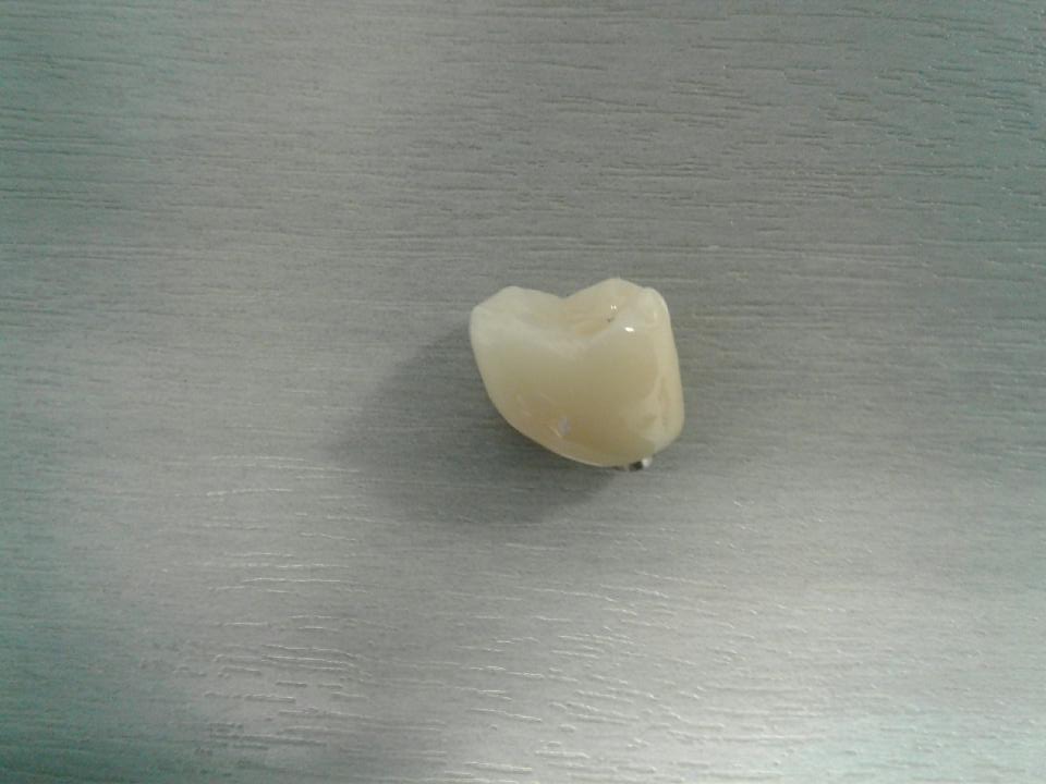 Screw Retained Zirconia