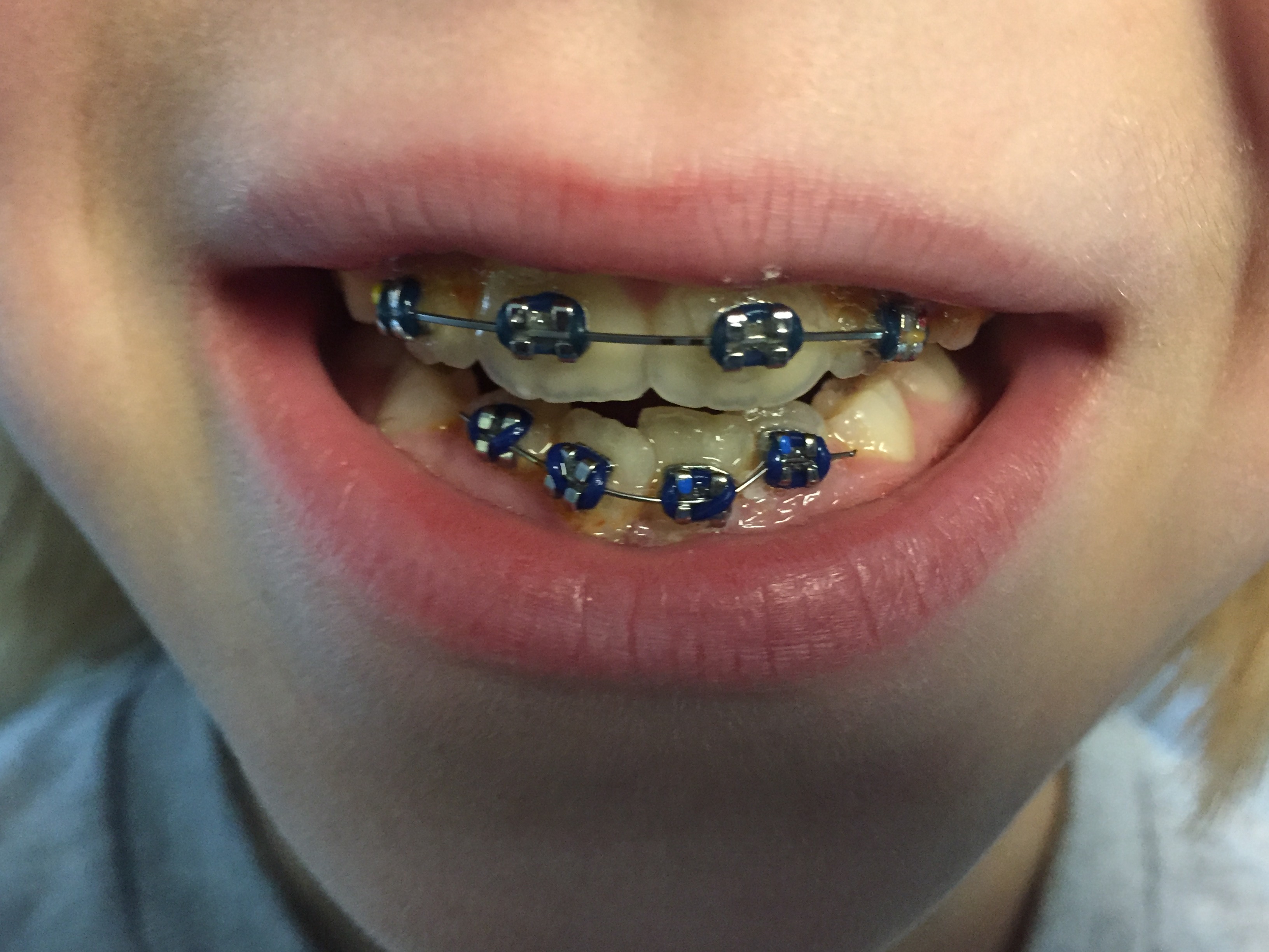 Phase 1 Treatment 
