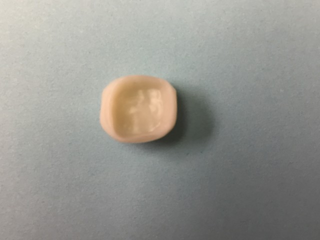 Cemented Retained Zirconia