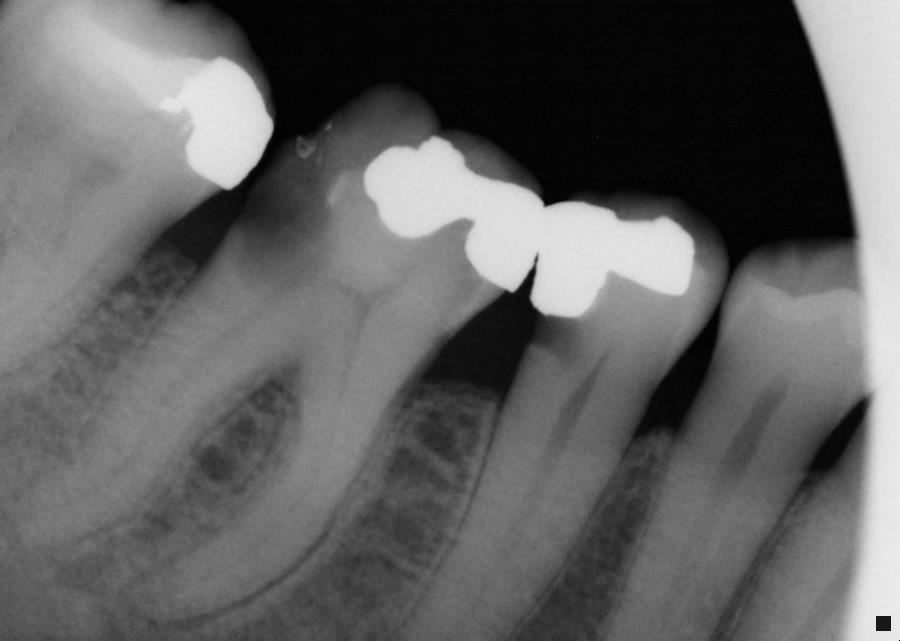 Molar Root Canals