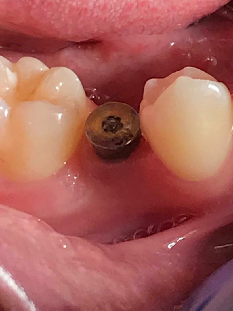 Lower Healing Abutment