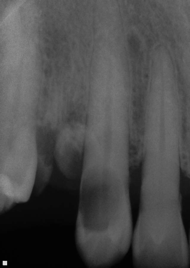 Anterior Root Canal
