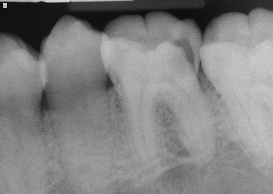 Fractured Tooth (needing RCT)