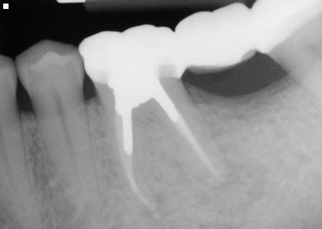 Molar Tooth with RCT/Post