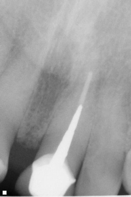 Anterior Root Canal with Post