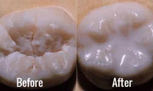 Dental Sealant