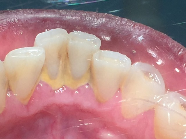 3 or Less Teeth SRP