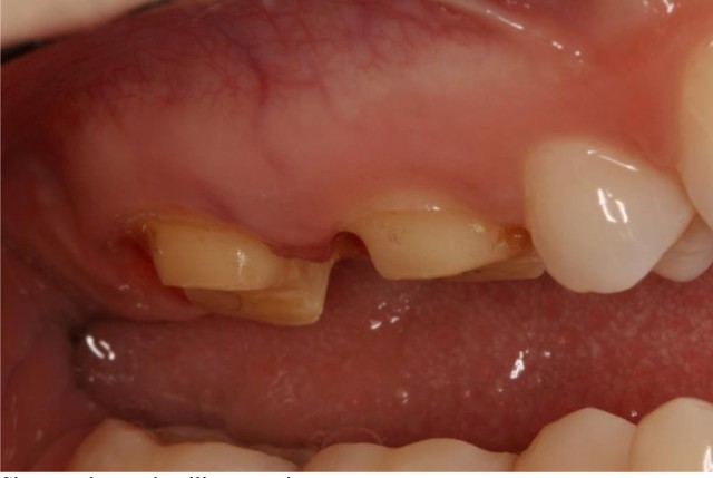Short Clinical Crowns