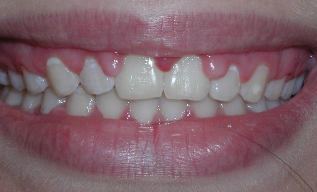 Teeth Needing Deep Cleaning