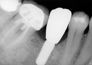 Dental Implants