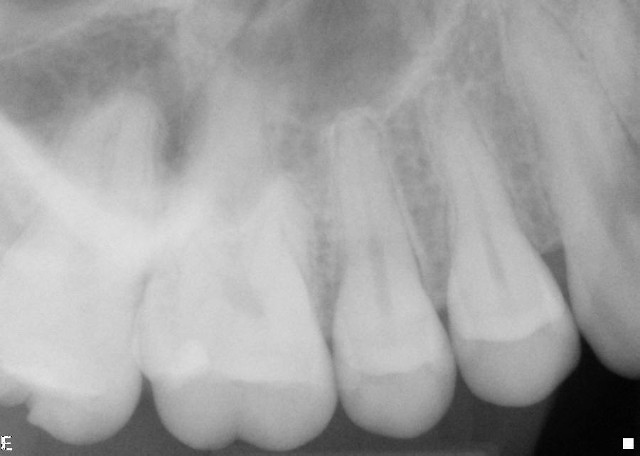 Upper Right Radiograph