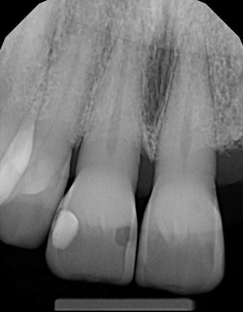 Upper PA Radiograph