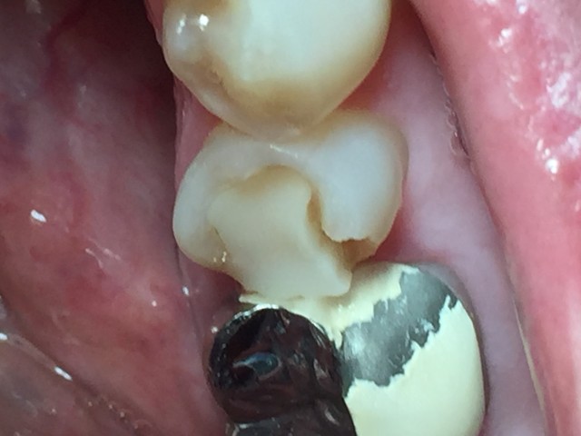 2 Surface Filling Premolar
