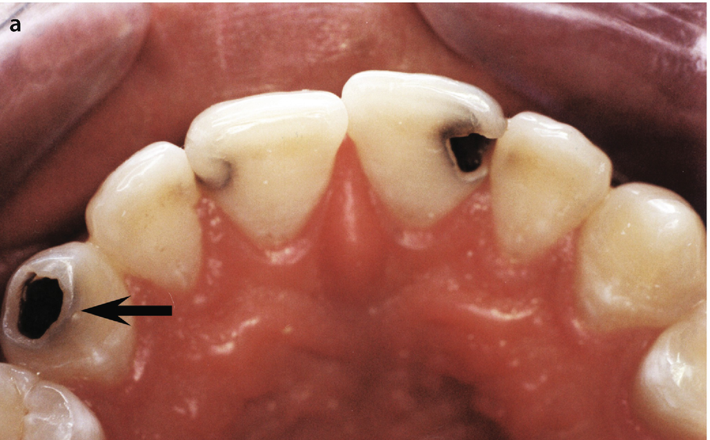 3 Surface Filling Anterior