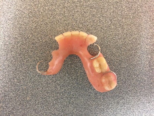 Acrylic Partial Denture