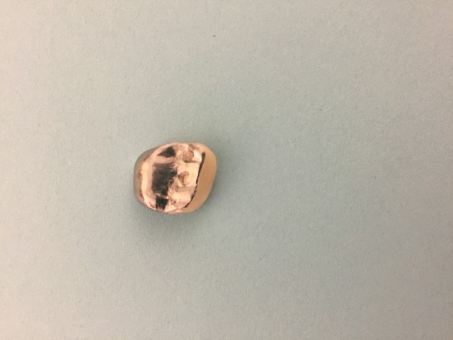 Lingual Metal-Facial Porcelain PFM