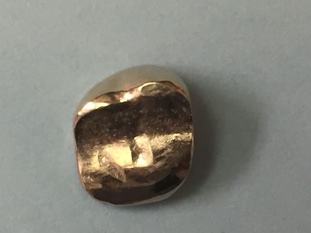Posterior Gold Crown