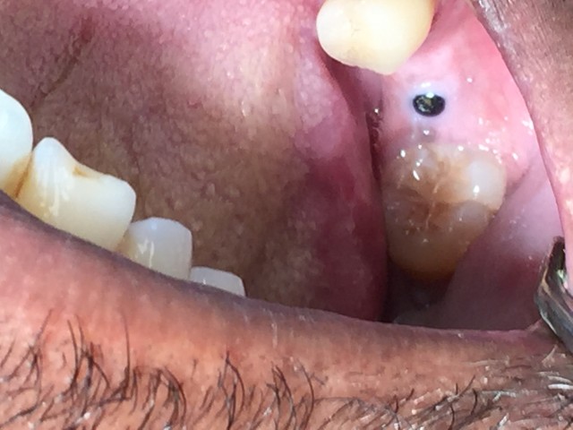 Lower Dental Implant