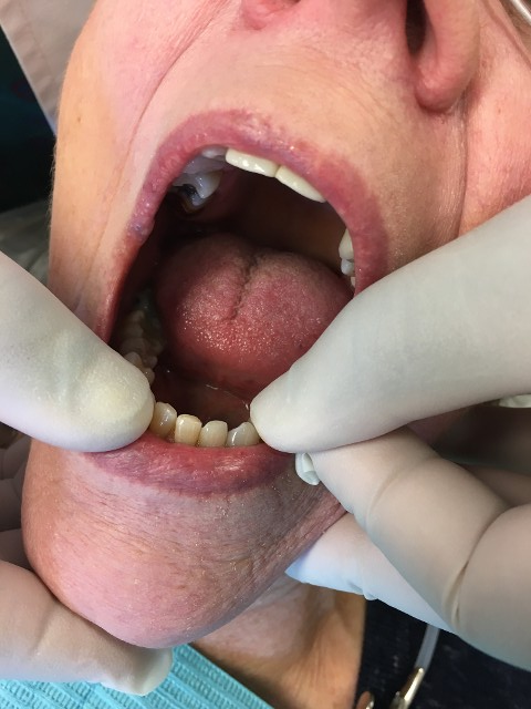 Finger Palpation Test 