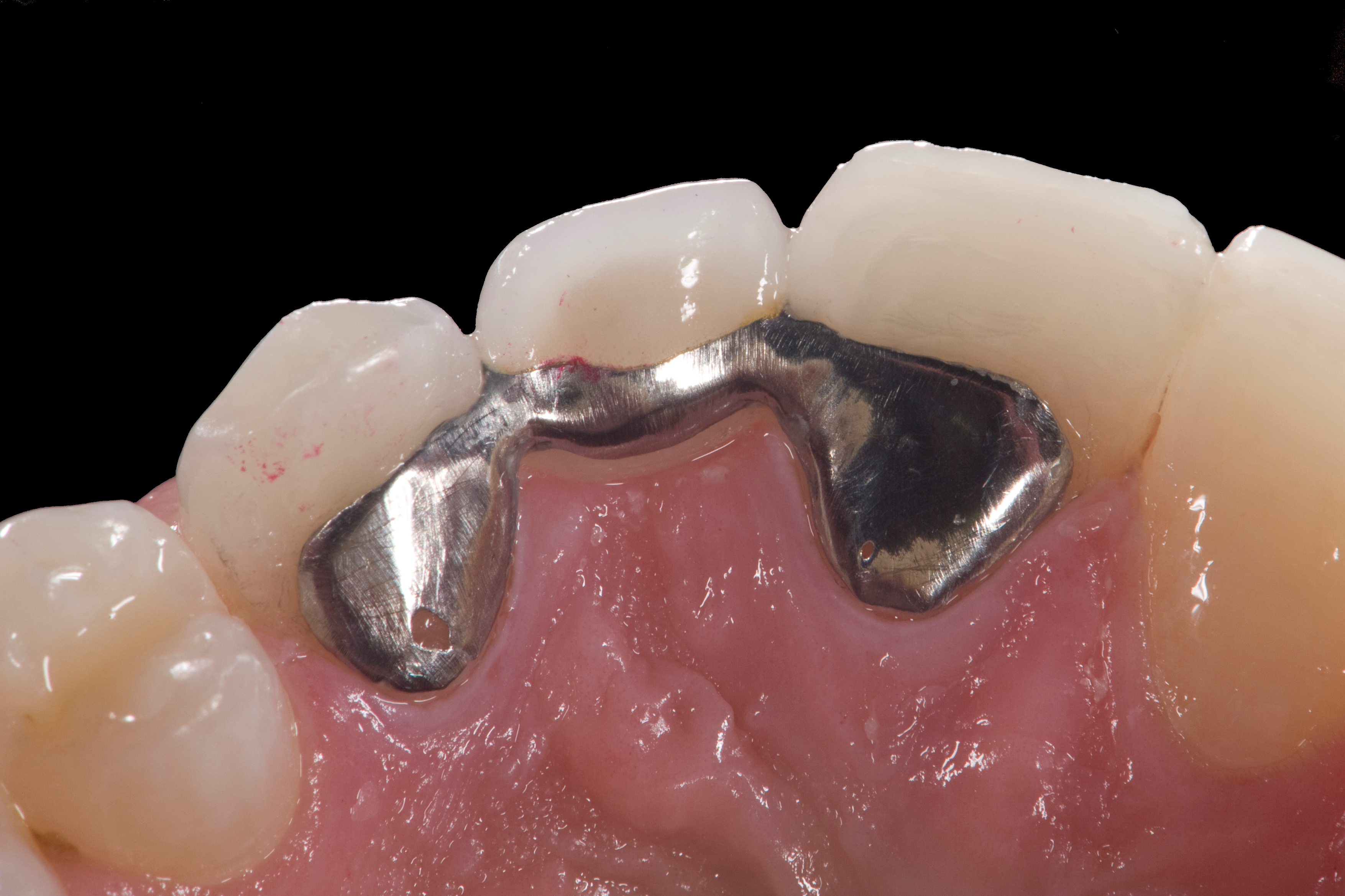 Anterior Maryland Bridge Closeup