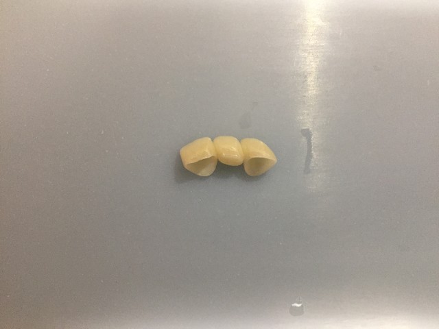 Anterior 2 Unit Bridge