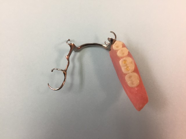Metal Framework Partial Denture Example 3