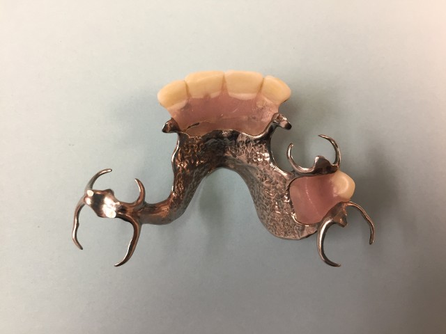Metal Framework Partial Denture Example 2