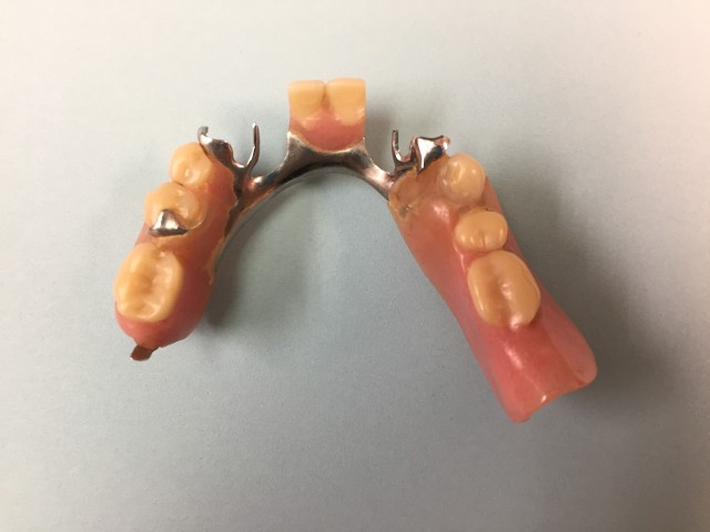 Partial Denture-