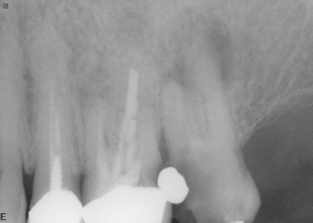 Severe Tooth Decay 