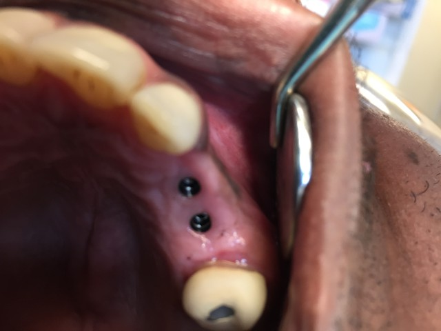 2 Upper Dental Implants