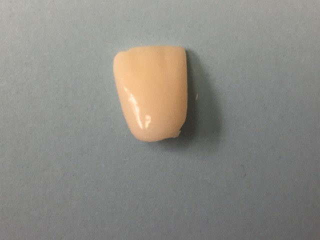 Anterior Zirconia Implant Crown