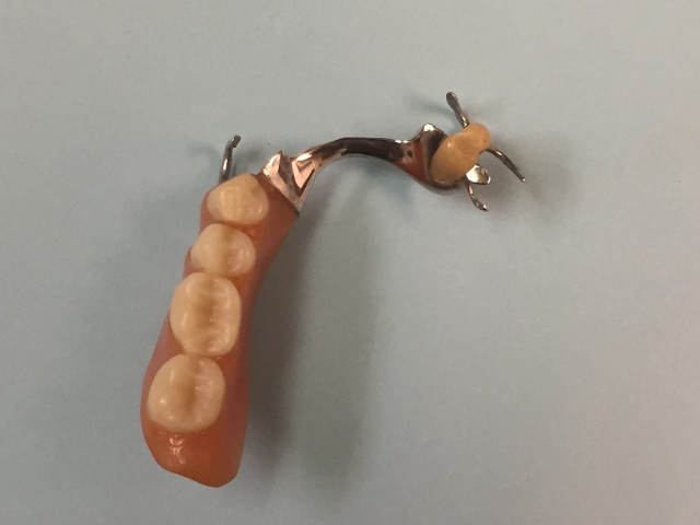 Metal Framework Partial Denture