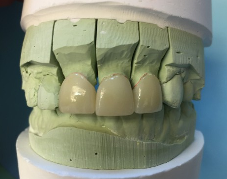 3 Anterior Crowns