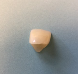 Anterior Zirconia Crown