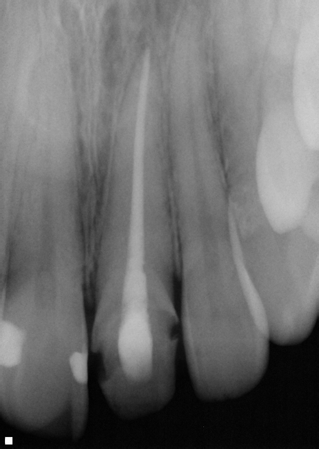 Anterior Root Canal- No Post