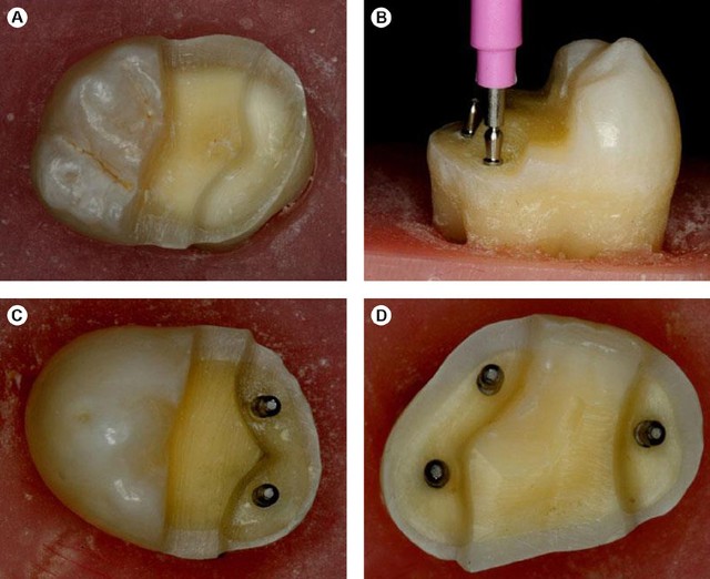 dental pins