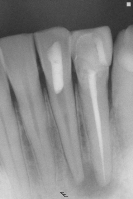 Lower Anterior RCT