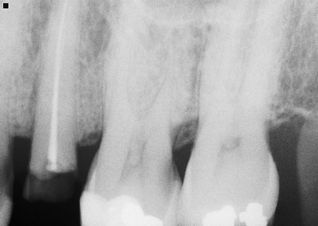 Upper Premolar RCT
