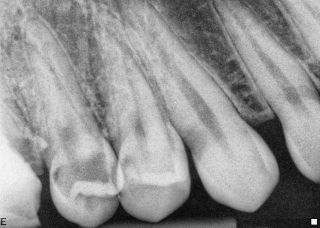 Premolar RCT