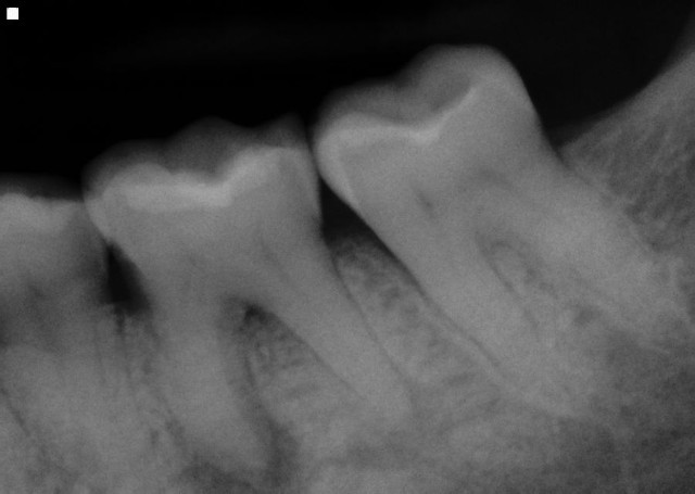 Lower Molar RCT
