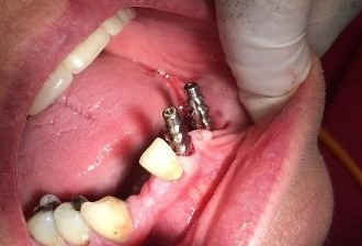 Dental Implants Impressions for Implant Bridge
