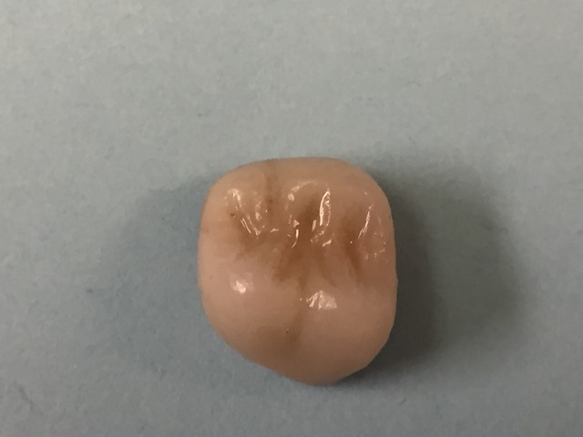 PFM crown 